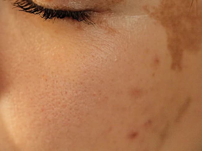 Close-up of uneven tone and pigmentation