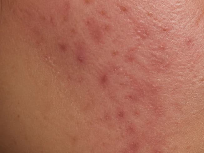 Close-up of breakout redness
