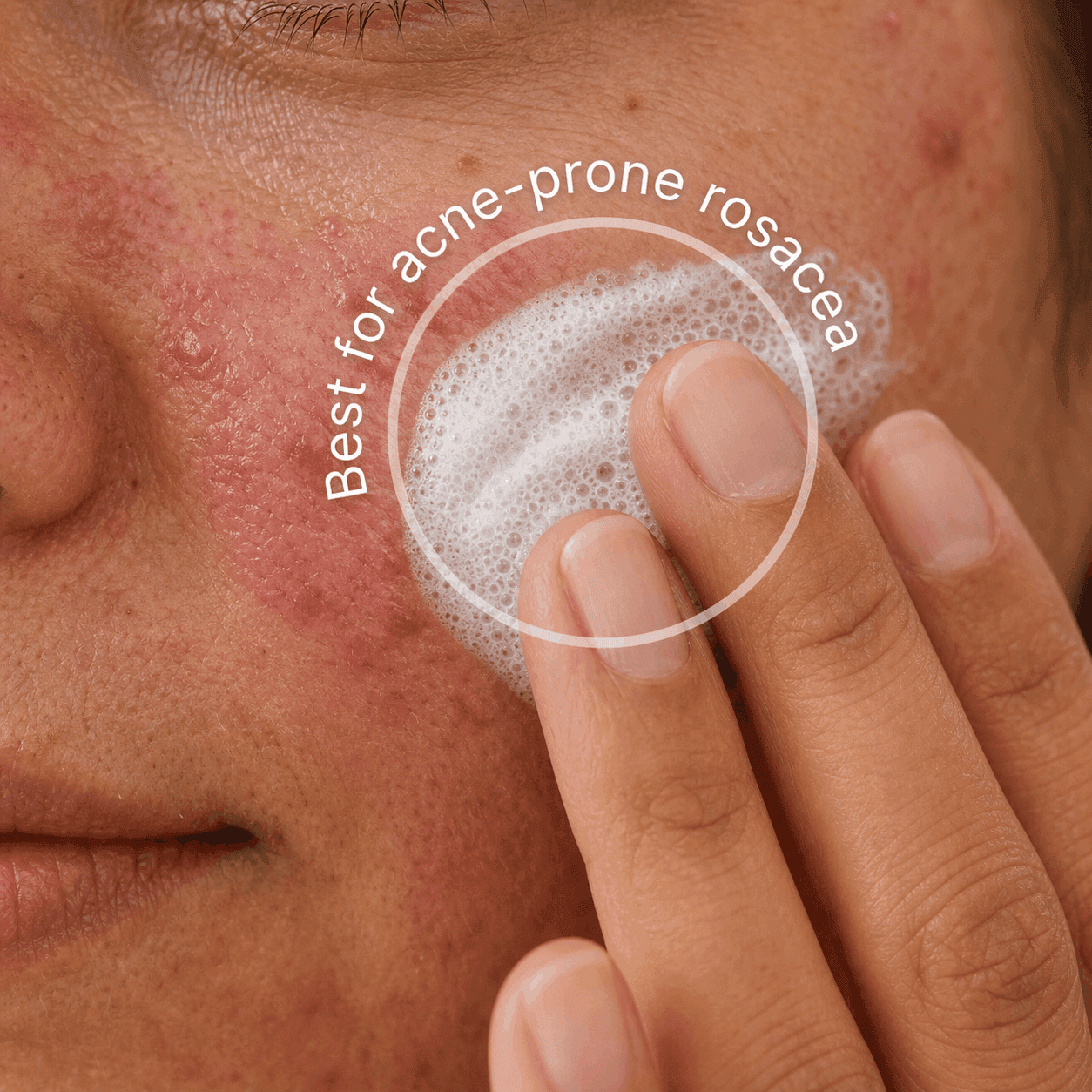 The Clarifying Rosacea Formula in use