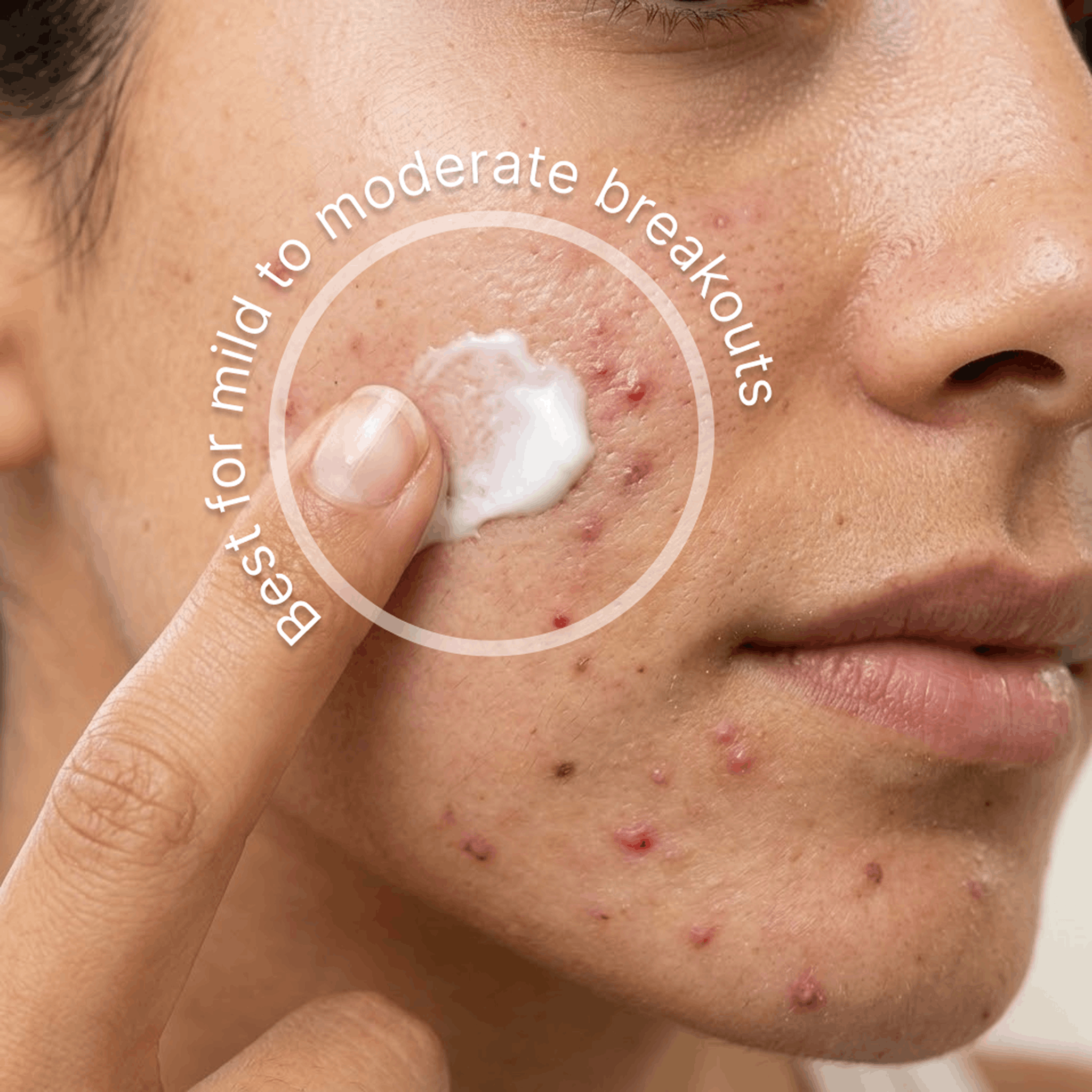 The Acne Solution best for mild to moderate breakouts