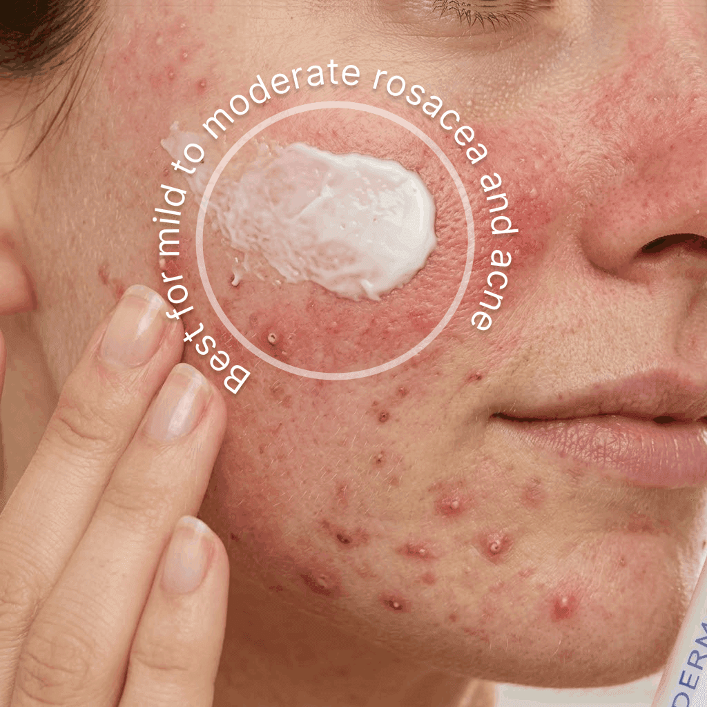 The Redness & Acne Formula best for mild to moderate rosacea and acne