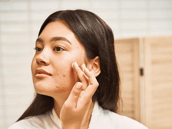 Applying acne treatment to acne-prone skin