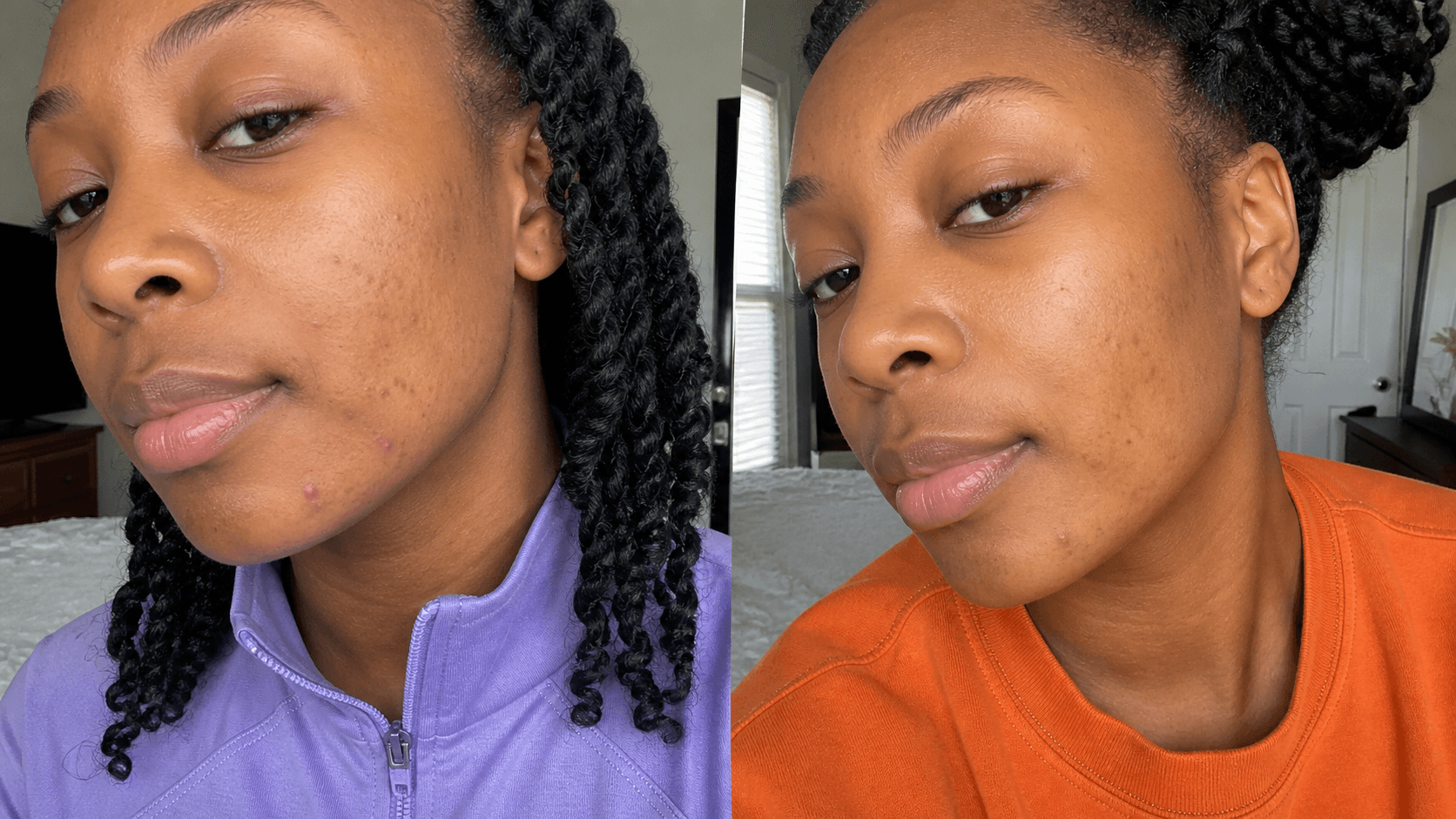 Chloe's acne before and after using The Acne Solution