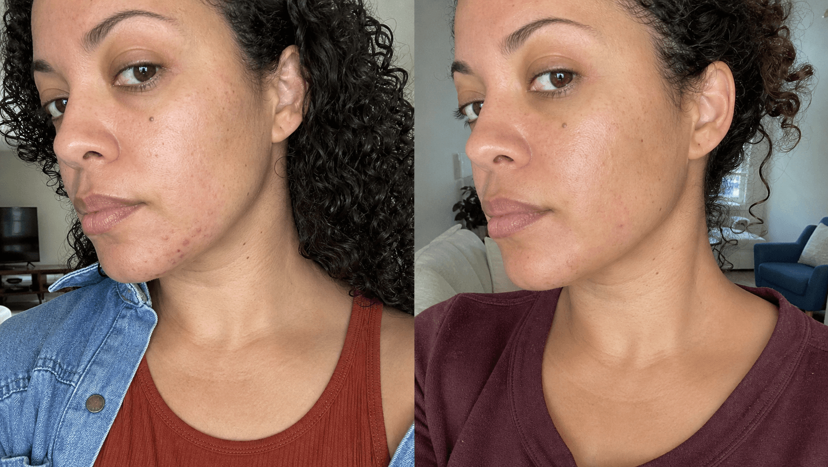 Emily's acne before and after using The Acne Solution