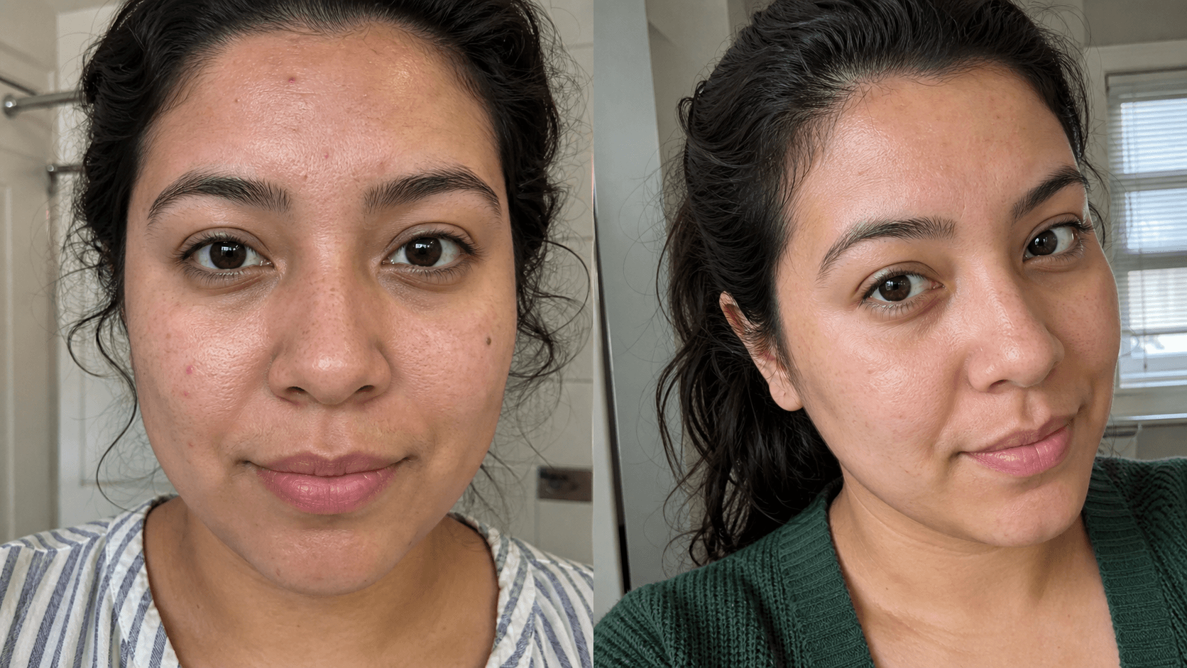 Jasmine's acne before and after using The Acne Solution