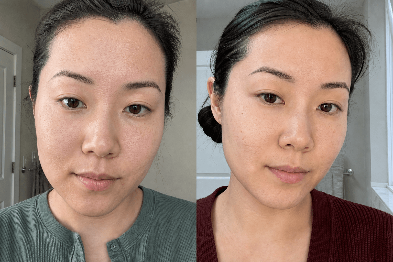Jordan's acne before and after using The Acne Solution