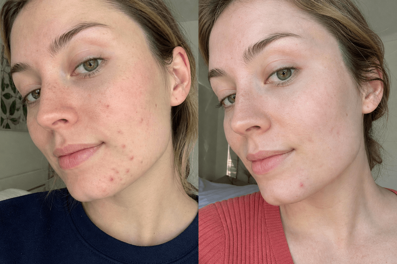 Maya's acne before and after using The Acne Solution