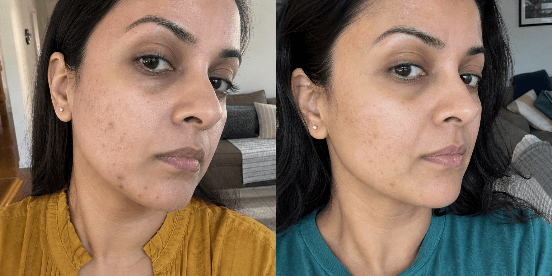 Nisha's acne before and after using The Acne Solution