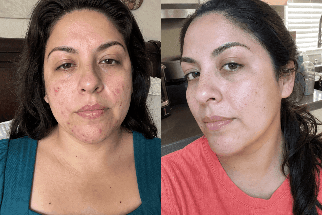 Alexis's acne before and after using The Advanced Acne Solution