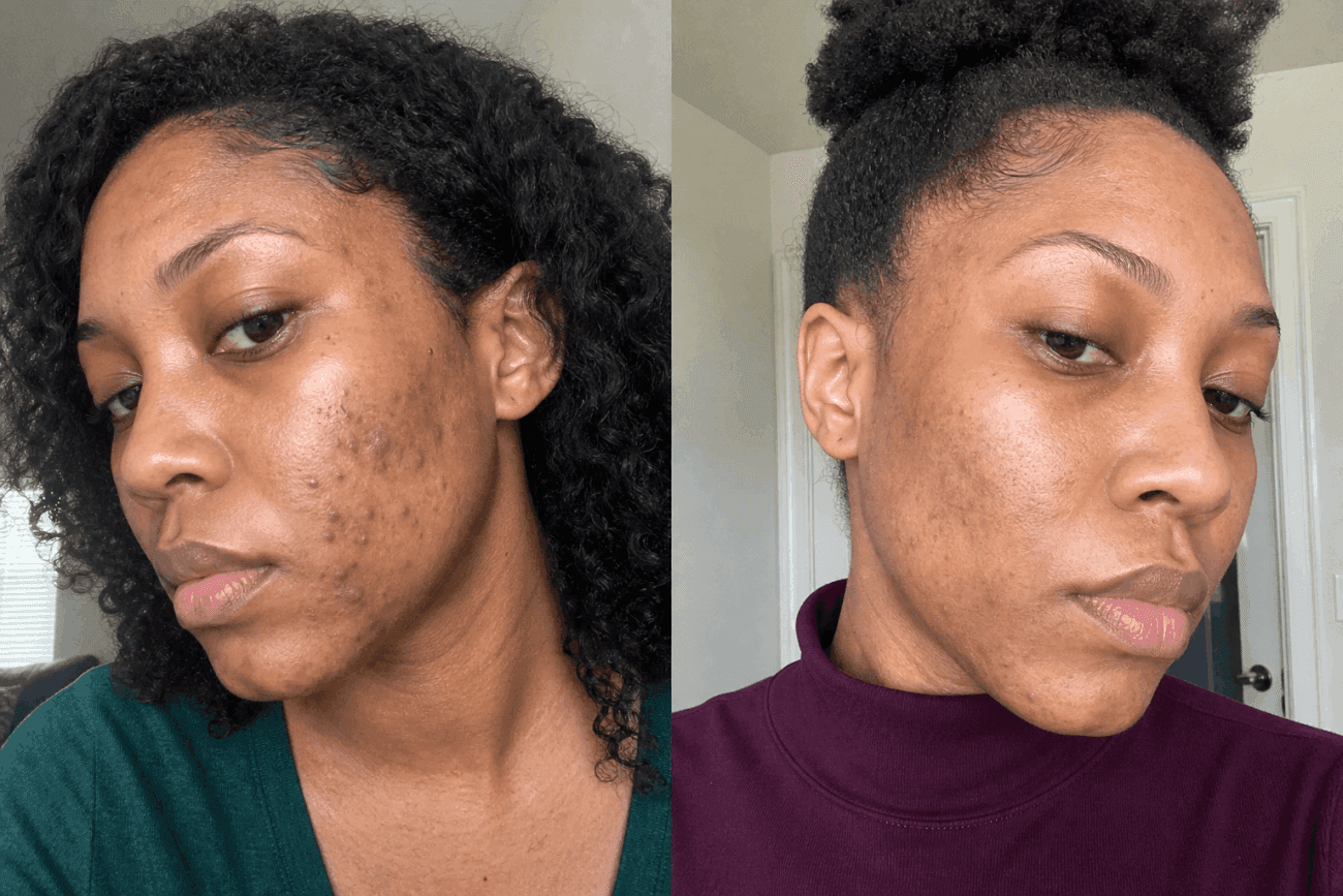 Danielle's acne before and after using The Advanced Acne Solution