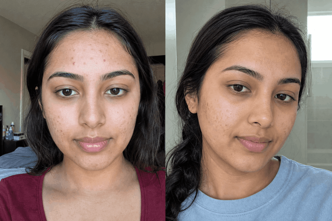 Kayla's acne before and after using The Advanced Acne Solution