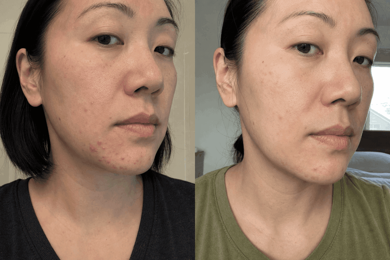 Nicole's acne before and after using The Advanced Acne Solution