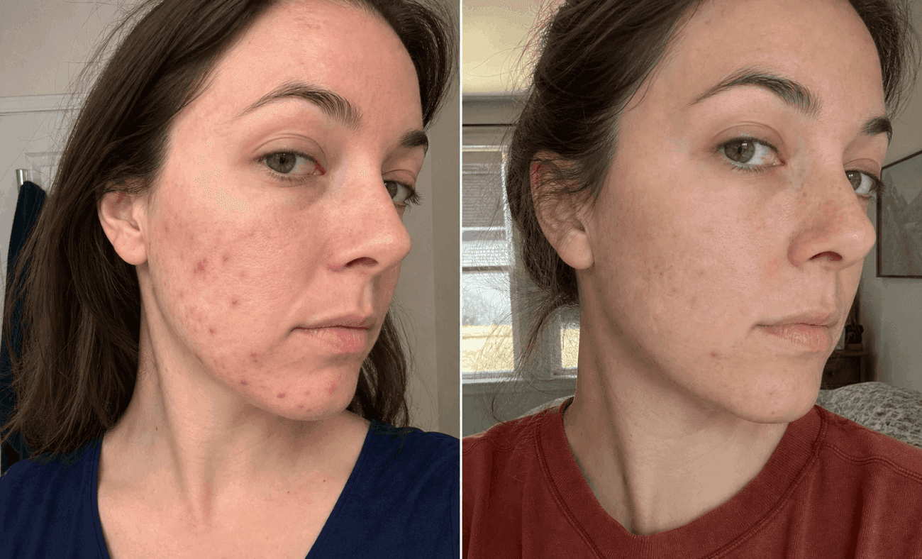 Rachel's acne before and after using The Advanced Acne Solution