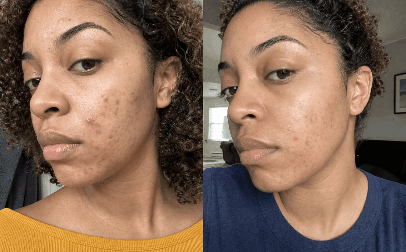 Tiana's acne before and after using The Advanced Acne Solution