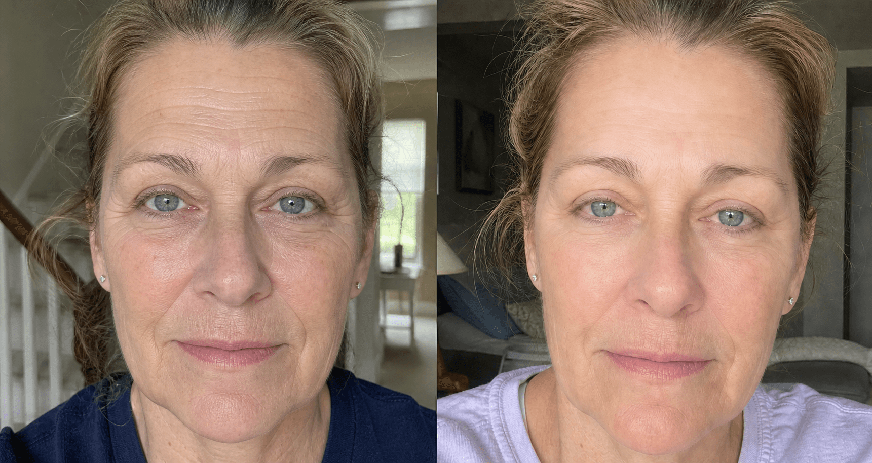 Karen's skin before and after using The Advanced Anti-Aging Solution