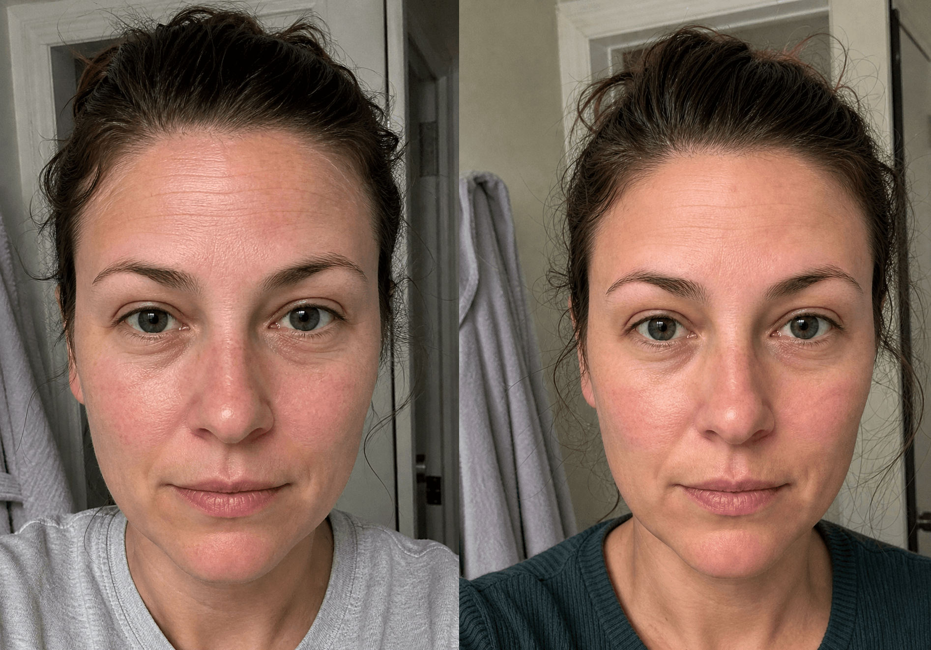 Emily's fine lines before and after using The Anti-Aging Solution