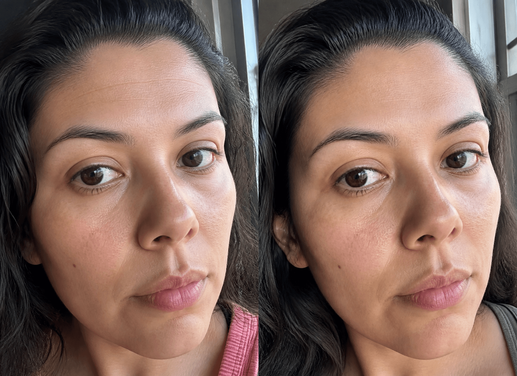 Megan's fine lines before and after using The Anti-Aging Solution