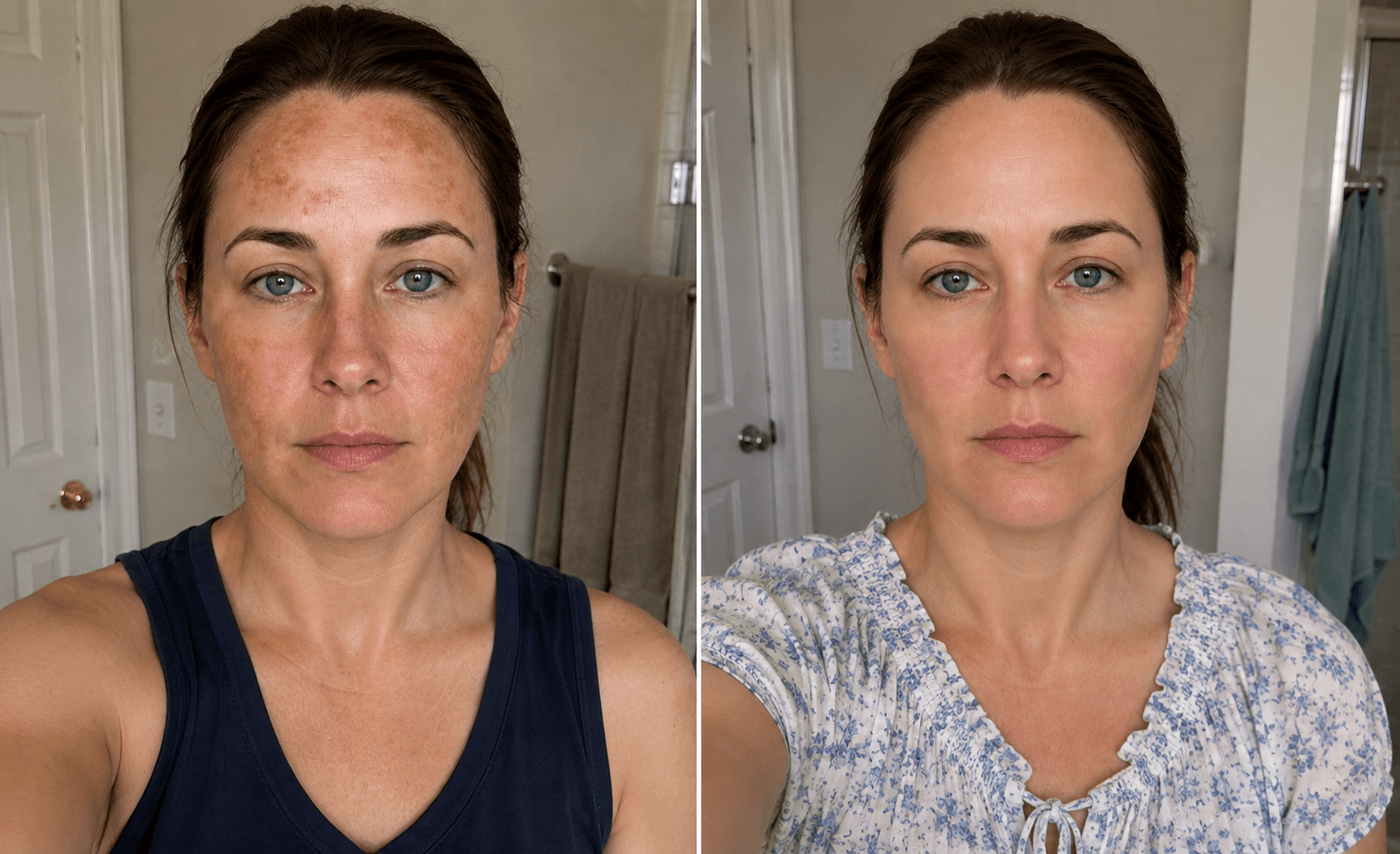 Ashley's melasma before and after using The Brightening Solution