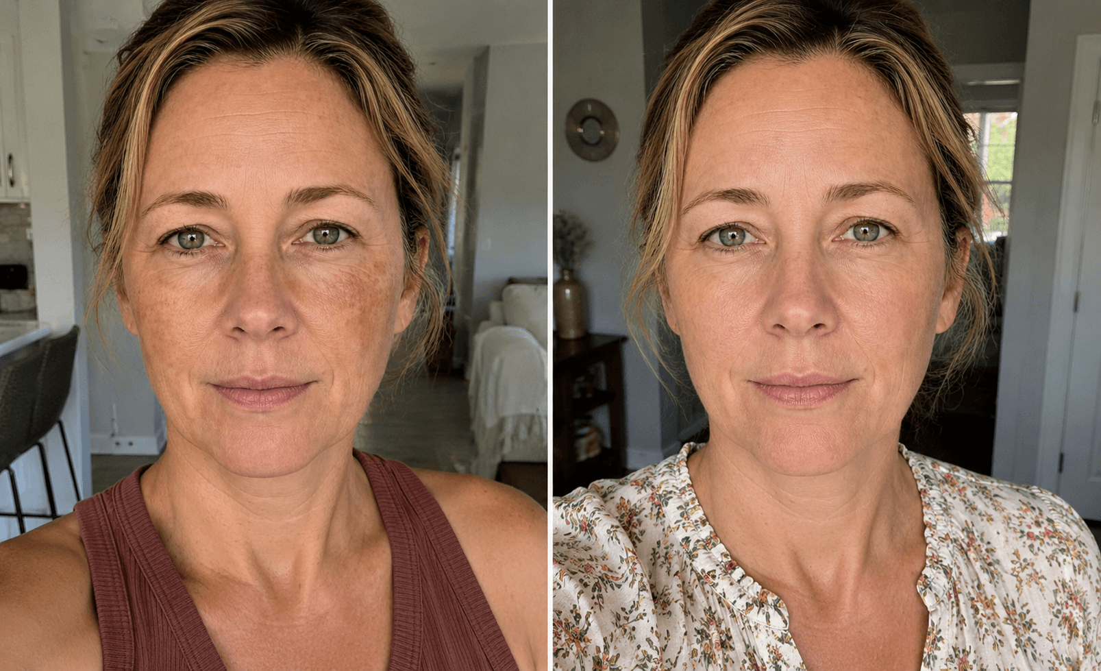 Sarah's melasma before and after using The Brightening Solution