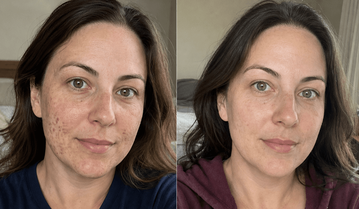 Amanda's dark spots before and after using The Dark Spot Solution