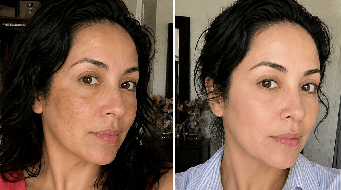 Elena's dark spots before and after using The Dark Spot Solution
