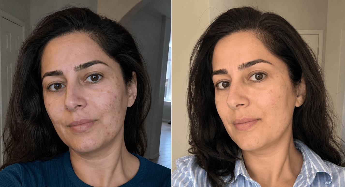 Hulya's dark spots before and after using The Dark Spot Solution