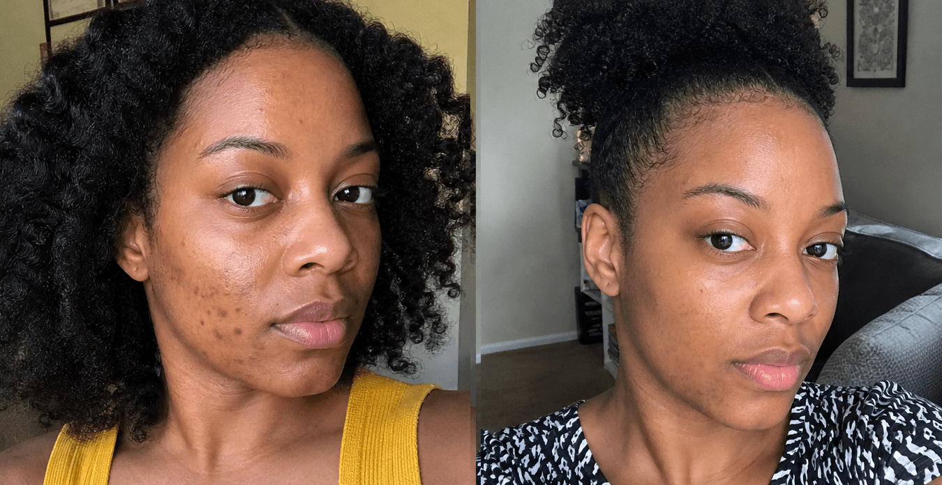 Jasmine's dark spots before and after using The Dark Spot Solution