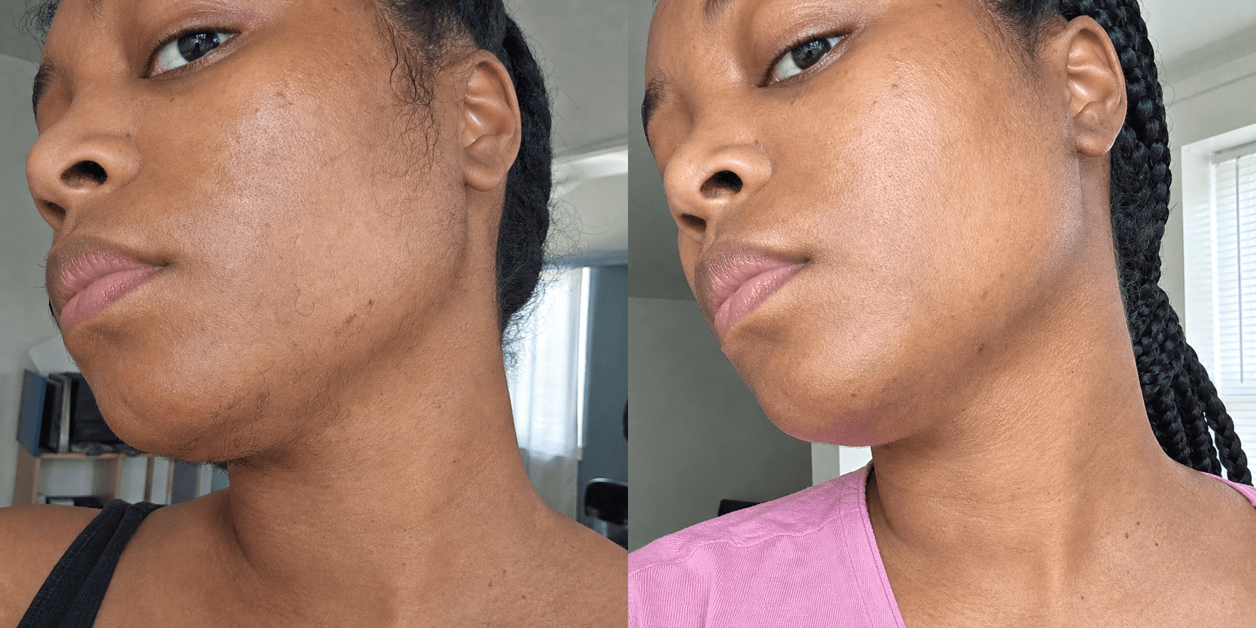 Aisha's jawline before and after using the Hair Reduction Solution