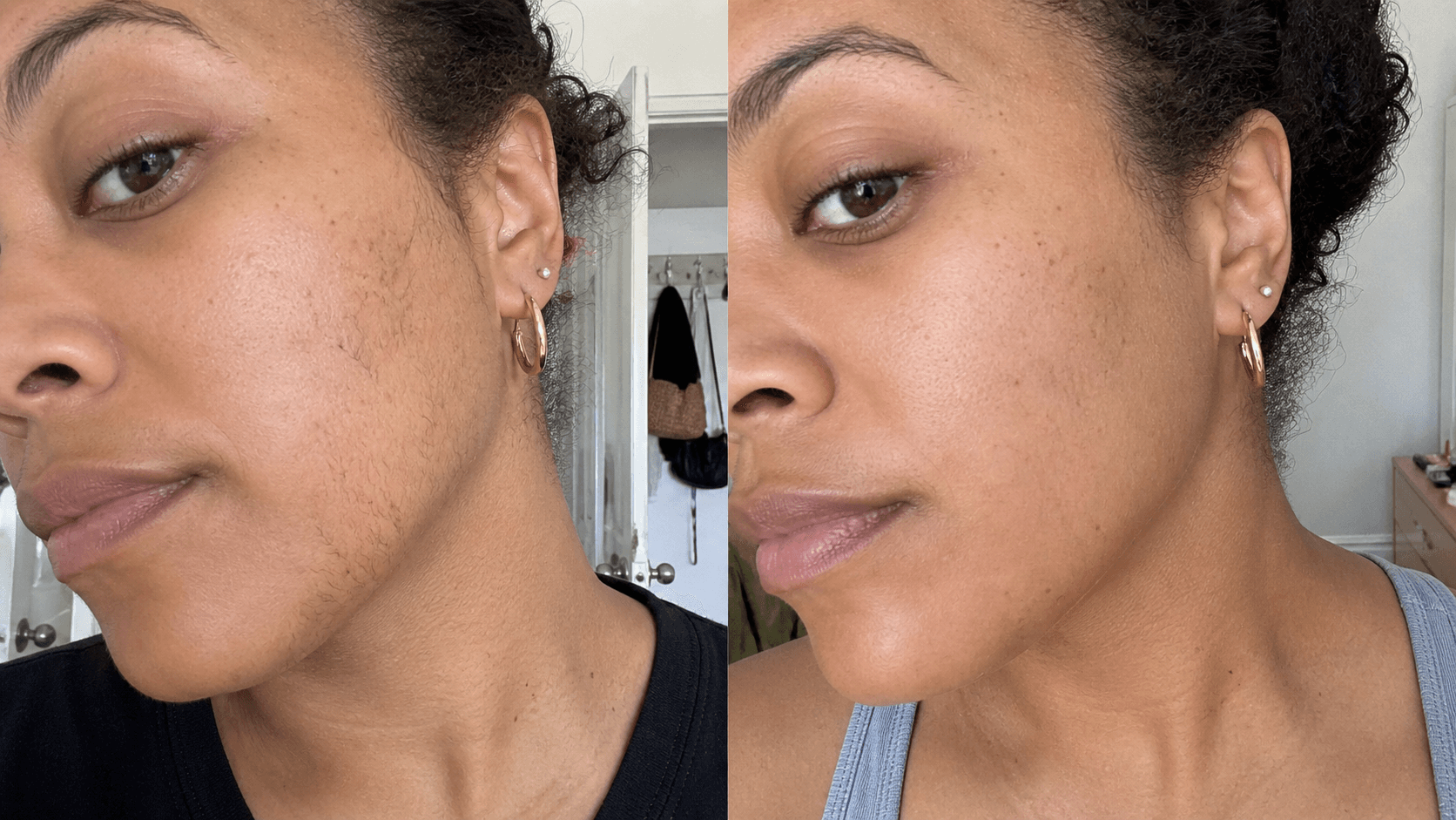 Nia's jawline before and after using the Hair Reduction Solution