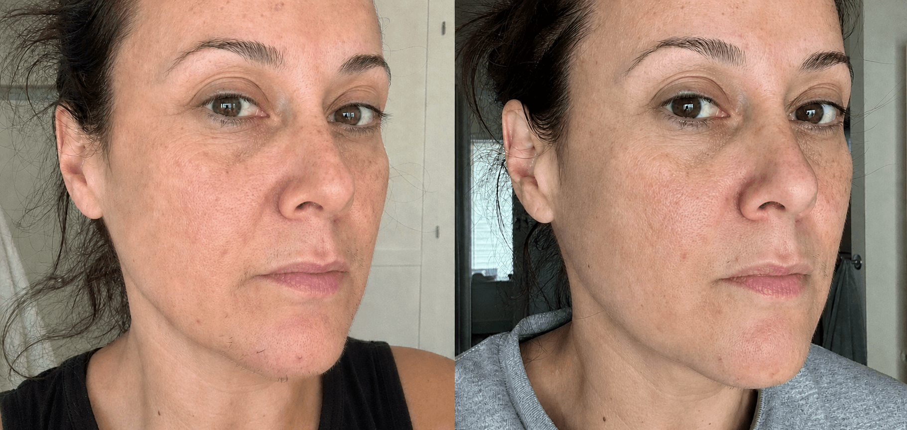 Tiana's chin and jawline before and after using the Hair Reduction Solution