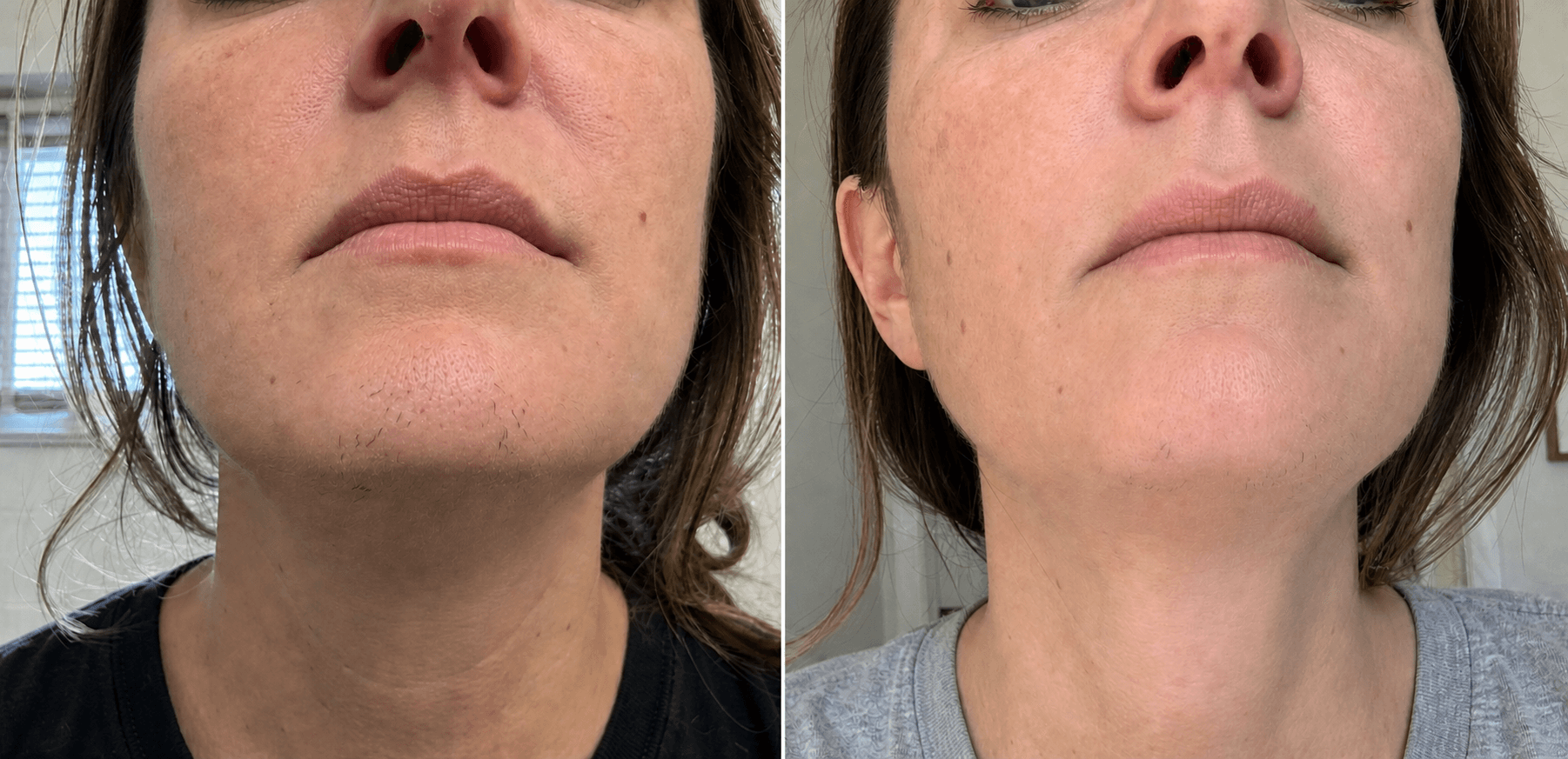 Monica's chin before and after using the Hair Reduction Solution