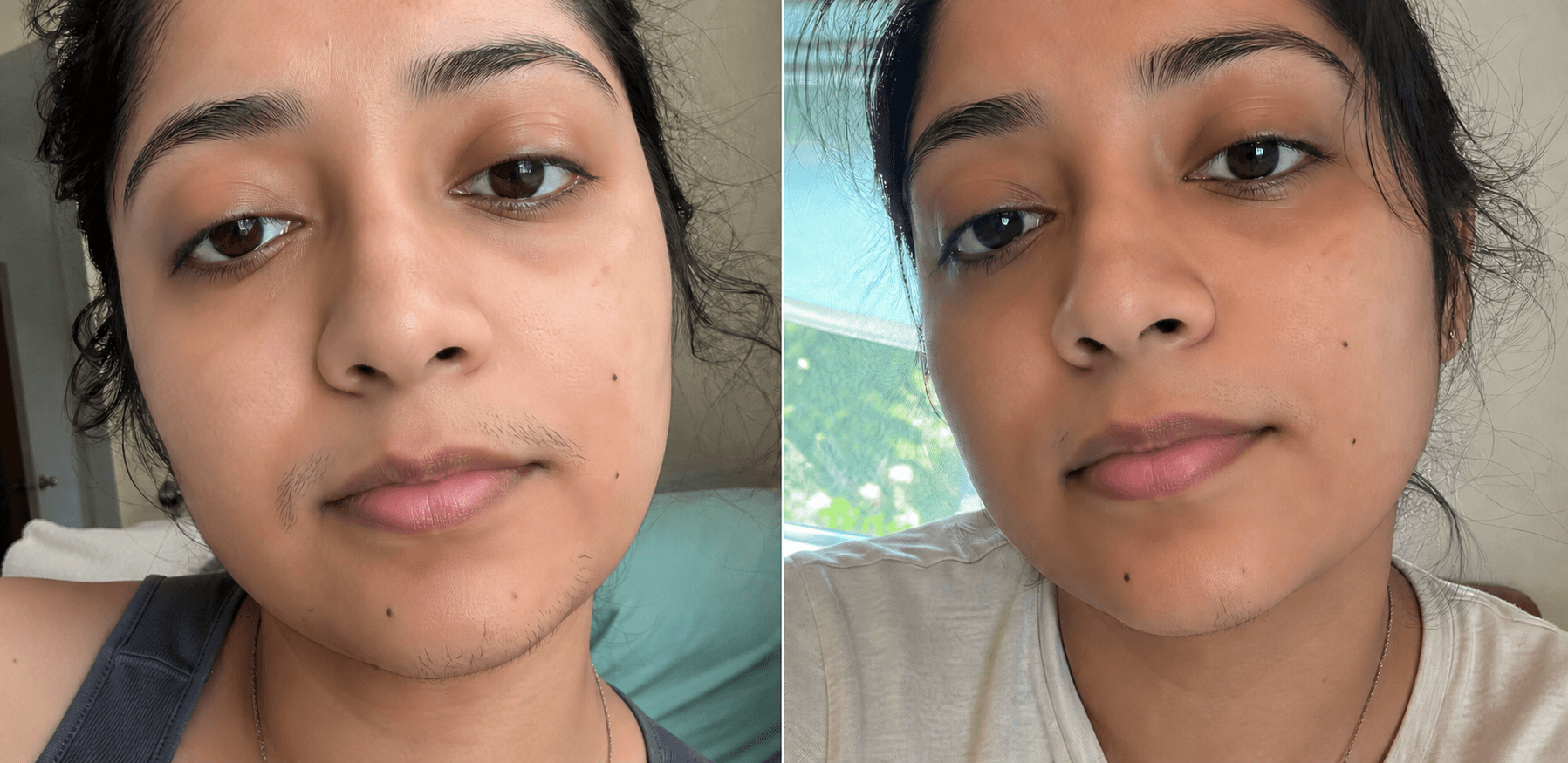 Anjali's chin before and after using the Hair Reduction Solution