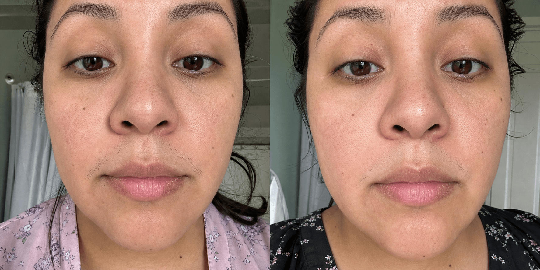 Vanessa's upper lip before and after using the Hair Reduction Solution