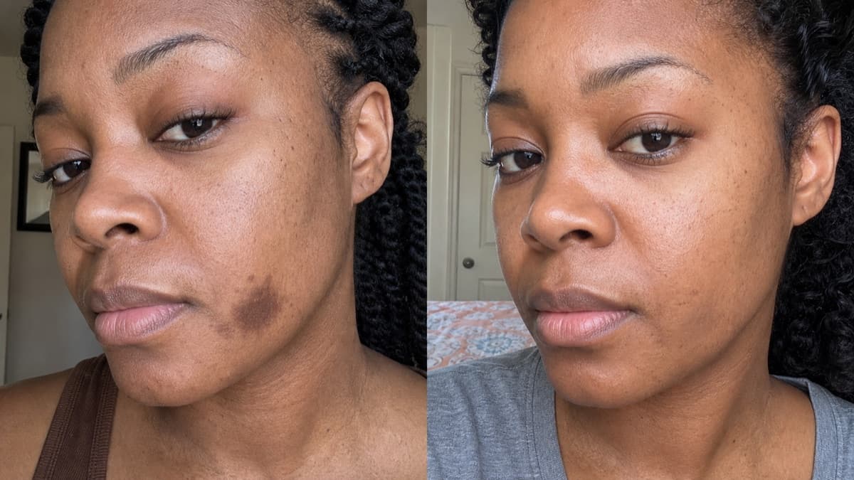 Alicia's post-acne dark mark before and after using The Precision Dark Spot Corrector