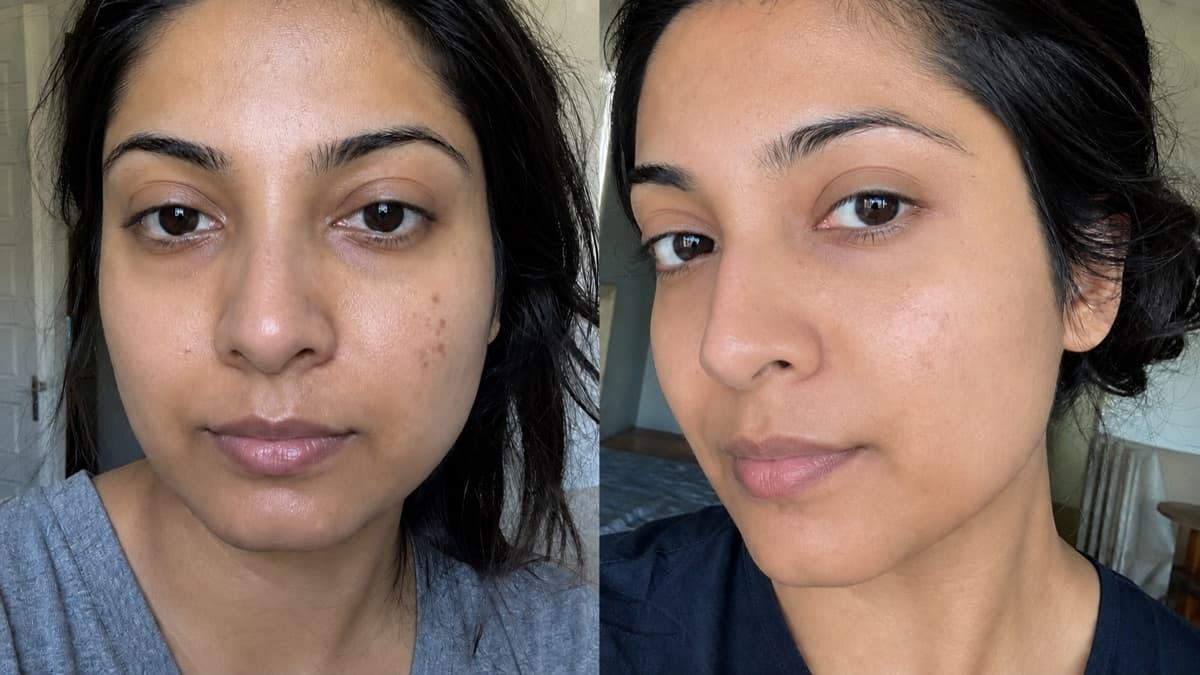 Nina's post-acne marks before and after using The Precision Dark Spot Corrector