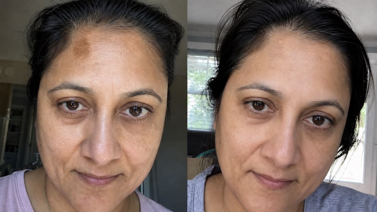 Priya's forehead pigmentation before and after using The Precision Dark Spot Corrector