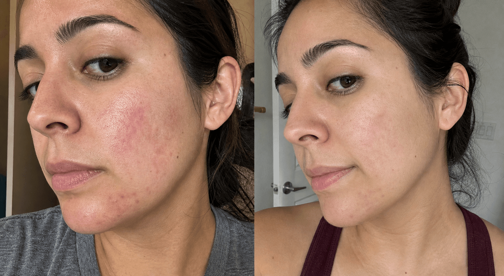 Camila's red marks before and after using The Red Mark Solution