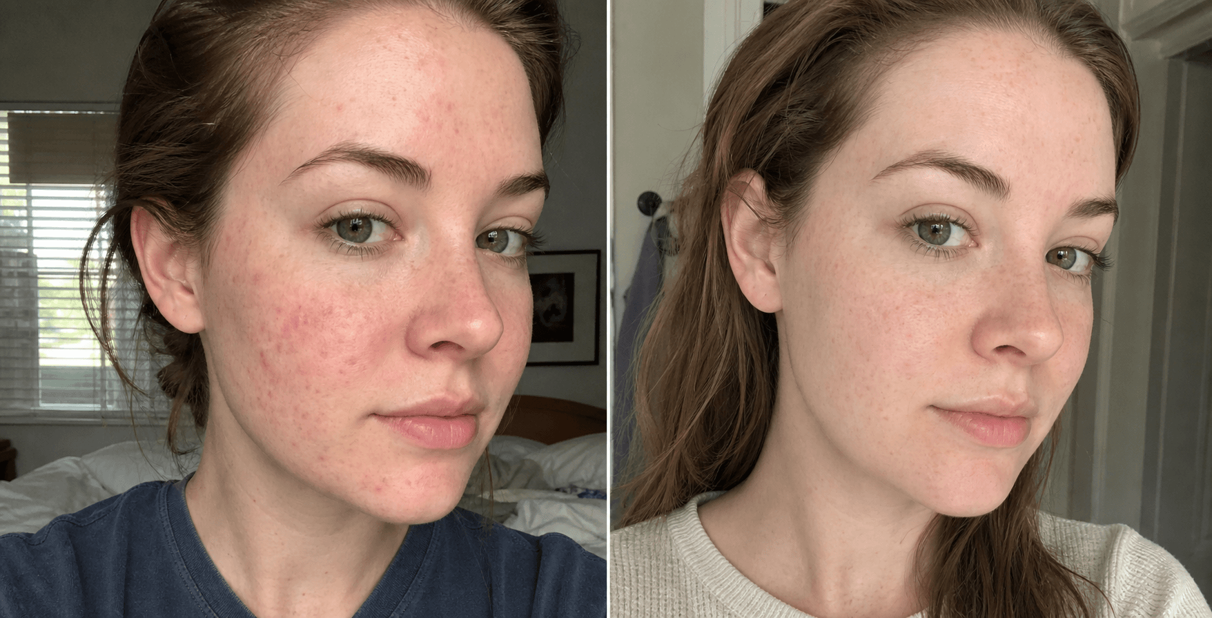 Chloe's red marks before and after using The Red Mark Solution
