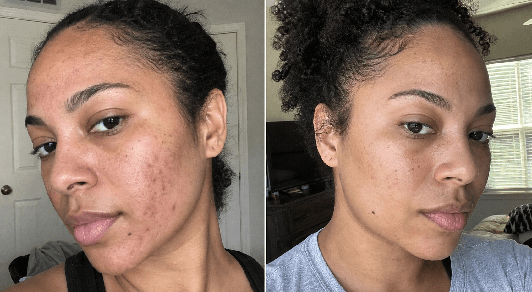 Zoe's red marks before and after using The Red Mark Solution