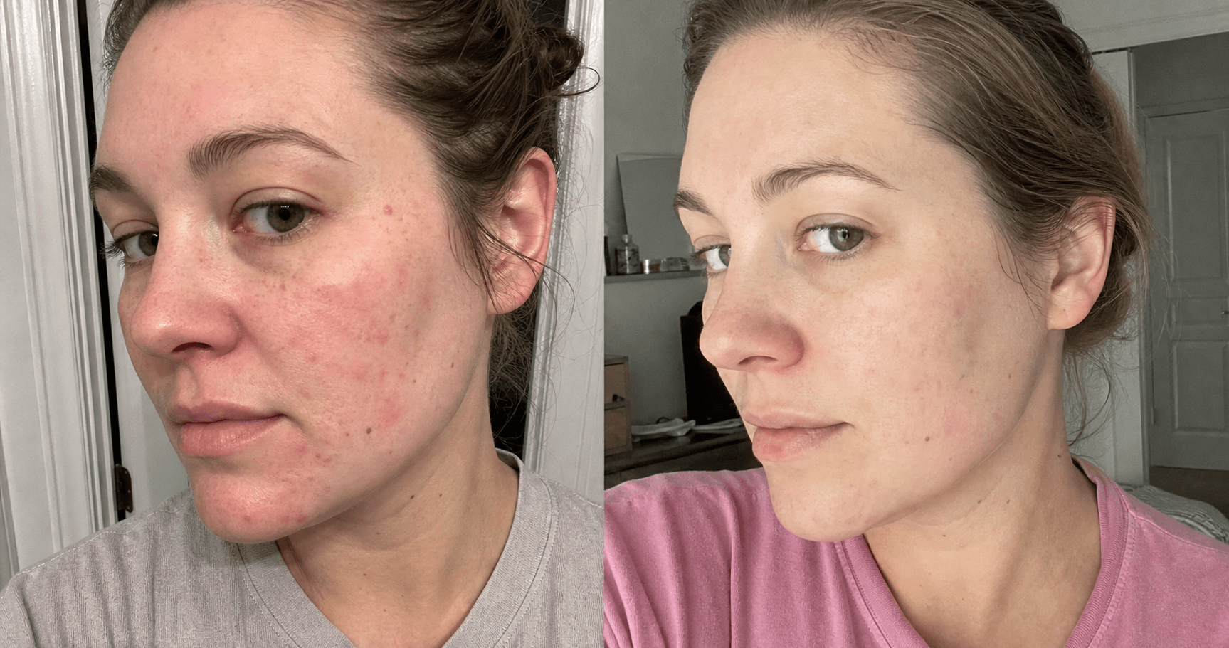 Rebecca's red marks before and after using The Red Mark Solution