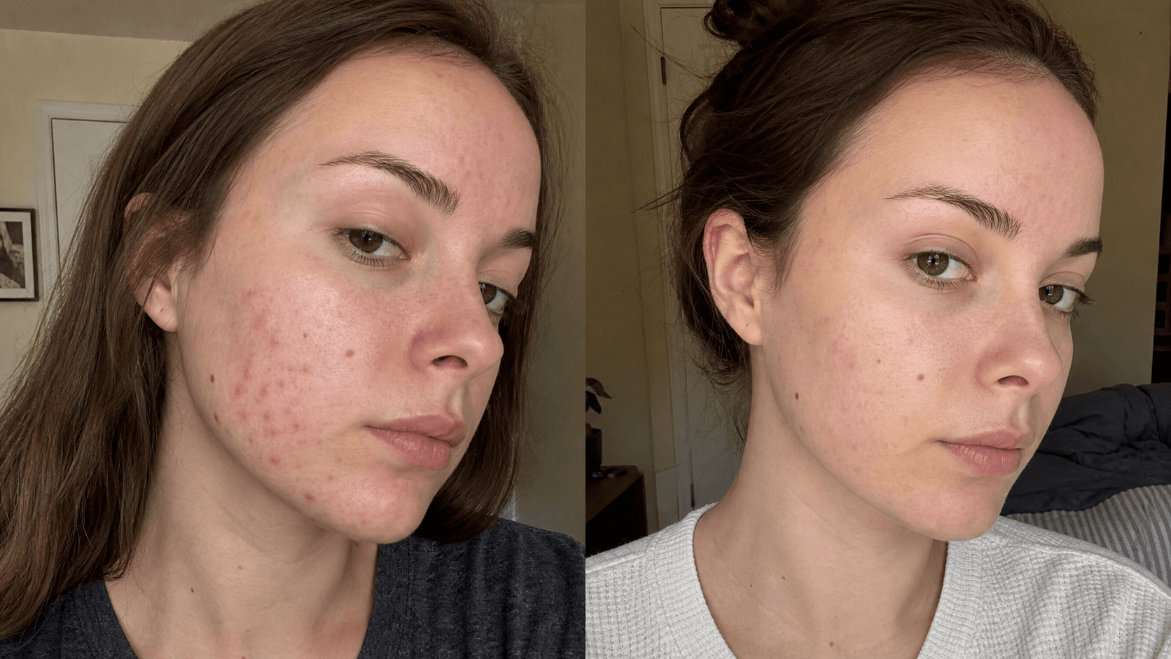 Madison's red marks before and after using The Red Mark Solution