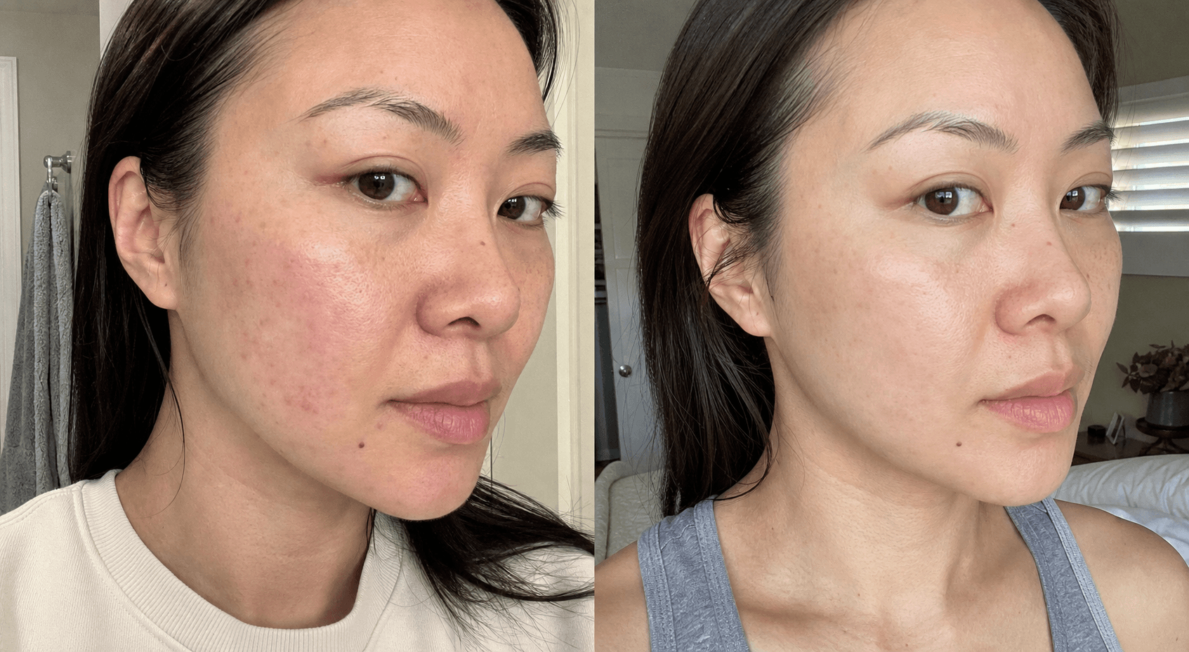 Audrey's red marks before and after using The Red Mark Solution