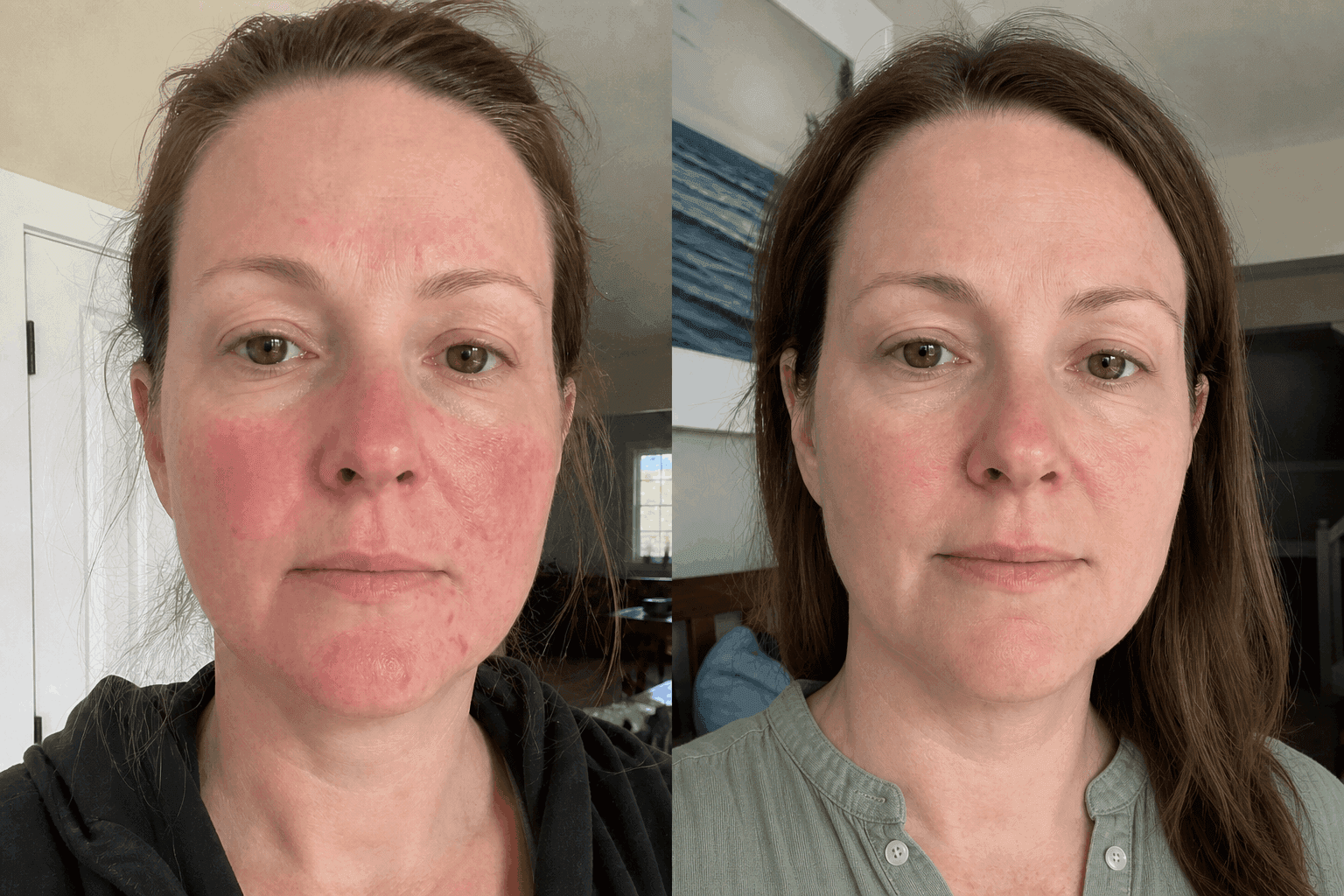 Caroline's before and after using The Advanced Redness Solution