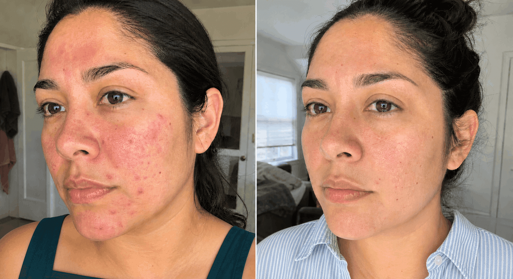 Gabriela's before and after using The Advanced Redness Solution