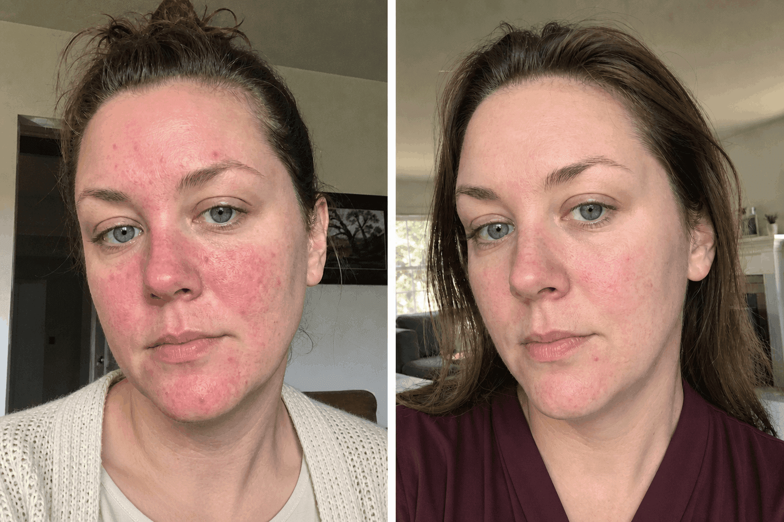 Hannah's before and after using The Advanced Redness Solution