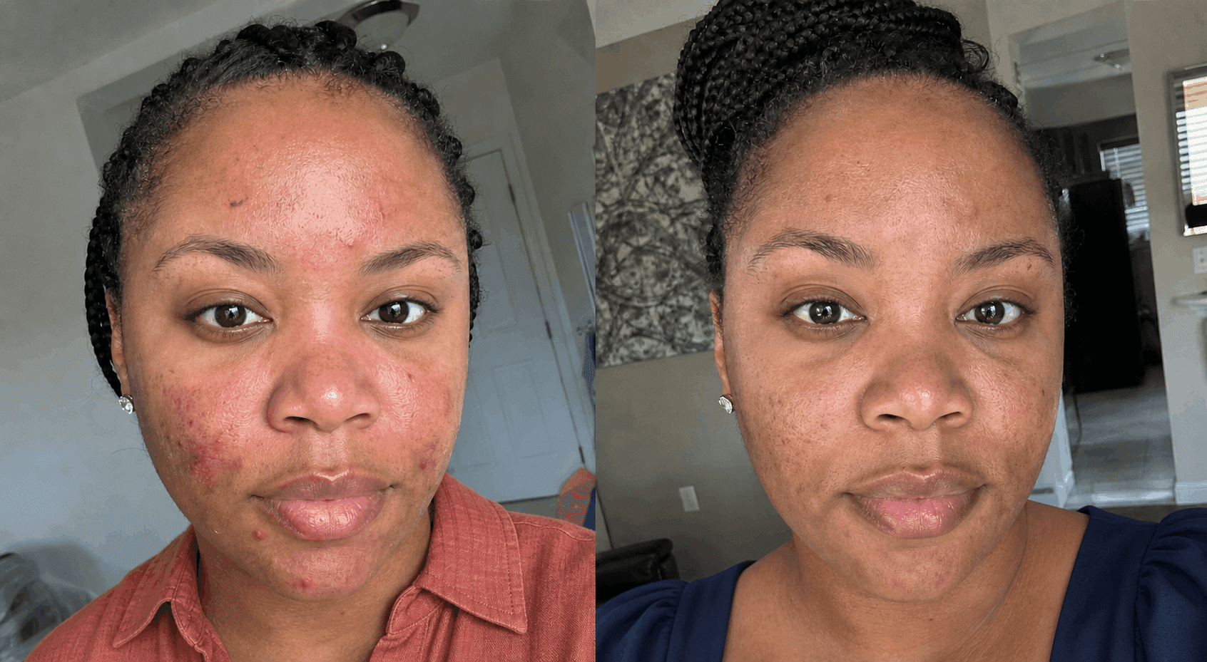 Keisha's before and after using The Advanced Redness Solution