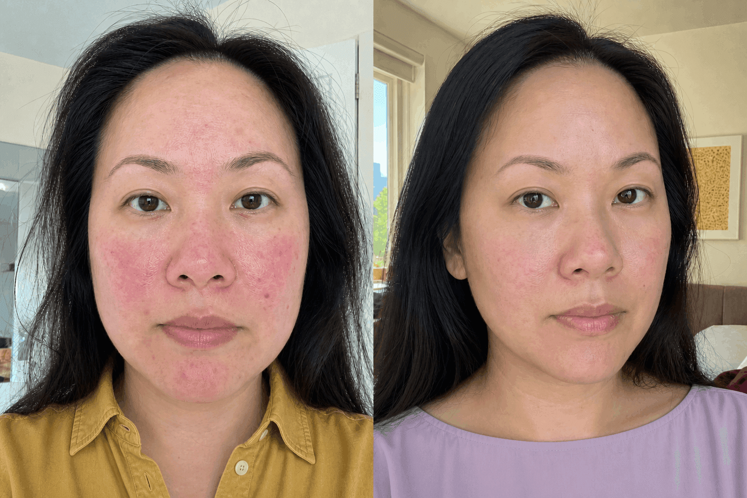 Mei's before and after using The Advanced Redness Solution