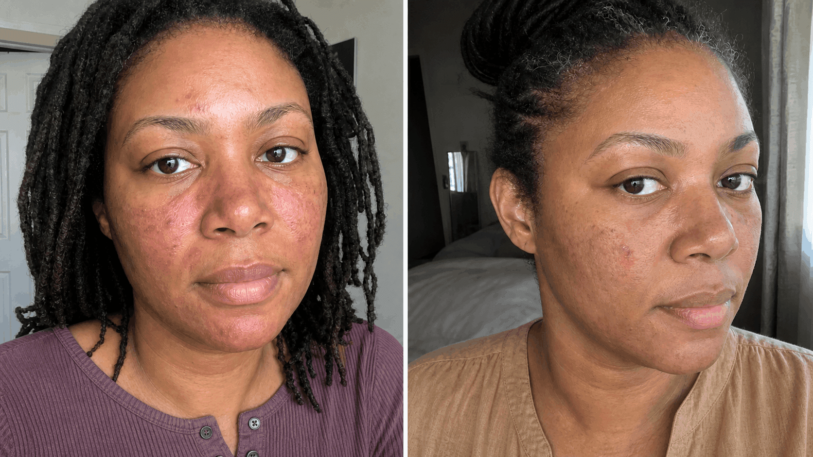 Naomi's before and after using The Advanced Redness Solution