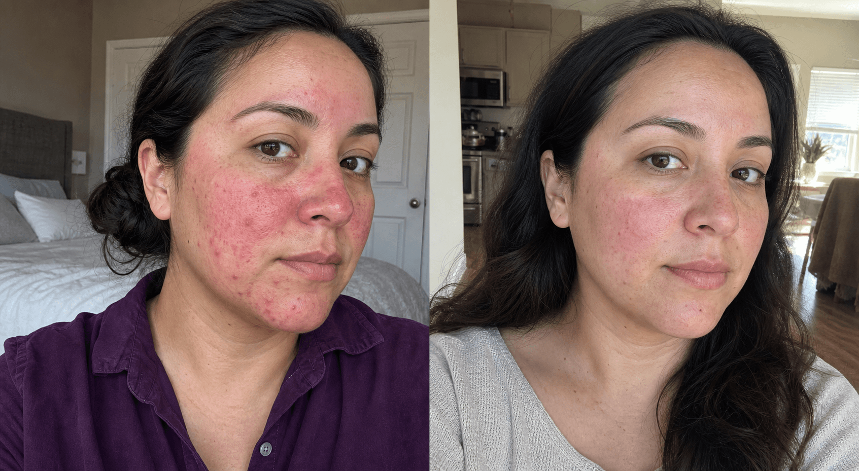 Adriana's before and after using The Clarifying Rosacea Formula