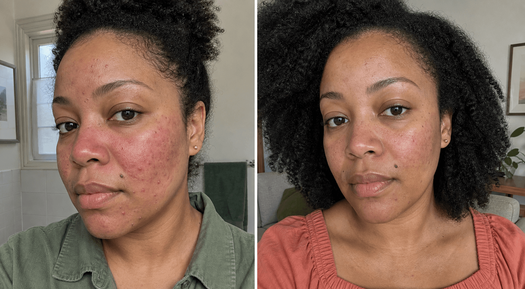 Brianna's before and after using The Clarifying Rosacea Formula